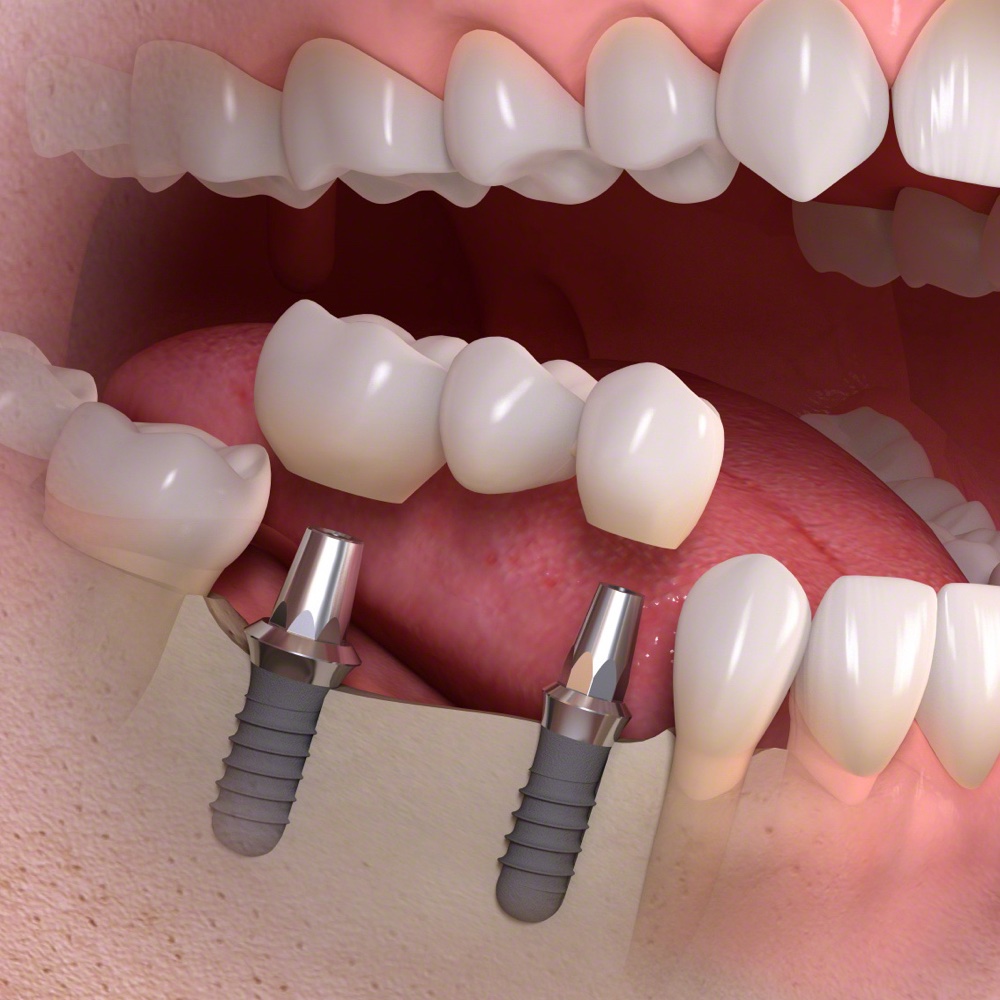 Illustration: zwei Implantate mit dreigliedriger Brücke im Unterkiefer