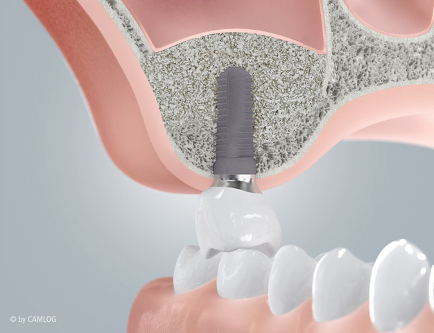 Querschnitt des seitlichen Oberkiefers mit aufgebautem Knochen unter der Kieferhöhle und einem Implantat mit Krone.